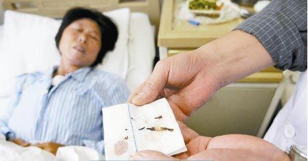 通過手術(shù)取出的針。　　商報記者 