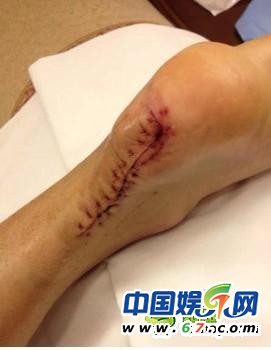 劉翔傷口拆線(xiàn)慘不忍睹
