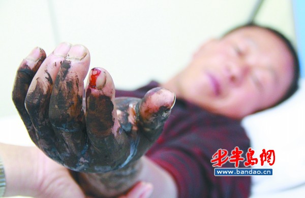 鄒先生的左手被蛇咬傷后明顯腫脹。