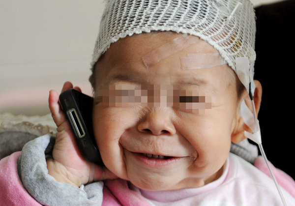 一歲半幼童酷似80老太 滿(mǎn)臉皺紋腿部一片褶子