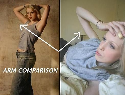 瘦到驚人的厭食癥患者