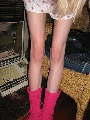 瘦到驚人的厭食癥患者