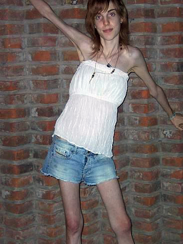 瘦到驚人的厭食癥患者