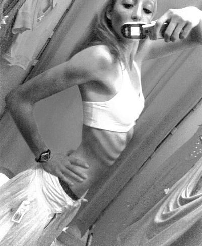 瘦到驚人的厭食癥患者