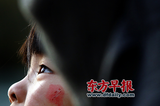 昨日，復(fù)旦大學(xué)附屬兒科醫(yī)院，7歲女童若若（化名）左邊臉頰還留有被劃破的傷痕。 早報(bào)記者 王辰 圖