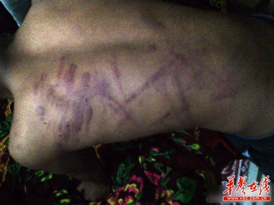 網(wǎng)曝云南省富源縣一名老師持續(xù)4小時體罰學(xué)生，期間打斷5根電線。（圖為被體罰學(xué)生）網(wǎng)絡(luò)截圖