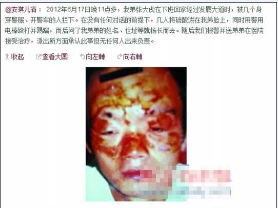 張大虎的姐姐將弟弟面部燒傷一事發(fā)上微博，引發(fā)網(wǎng)友廣泛關(guān)注。